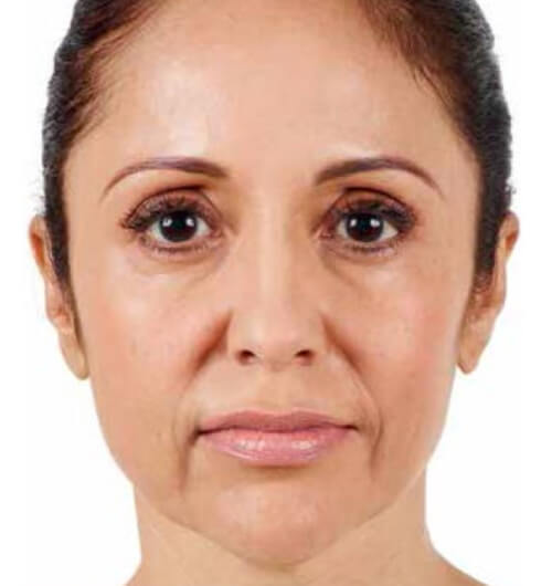 Lifting facial - Dermatólogo Quito - Dra. Augusta Valeria Alvarado